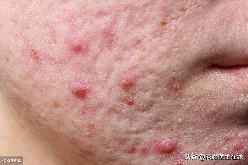 没躲开5个原因，脸上会开始长痘痘，很难消掉
