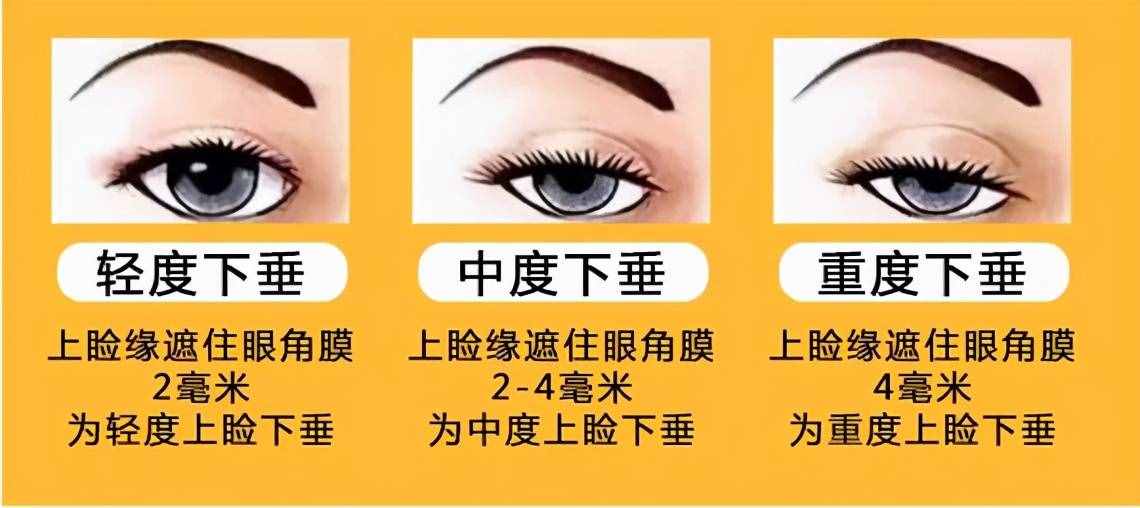 为什么从小就有抬头纹，眼睛还比别人小？