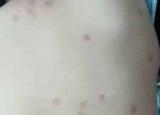 今日更新人身上被螨虫咬的图片（人身上被螨虫咬）