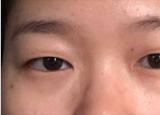 今日更新割个双眼皮多少钱(双眼皮手术)