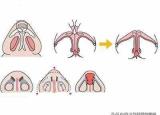 今日更新鼻翼缩小的方法（鼻翼缩小术三种常见方法）