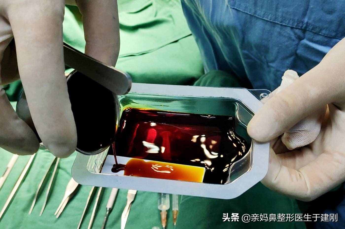 整形假体中膨体比硅胶更易感染?难取出?怎么还会有医生使用?