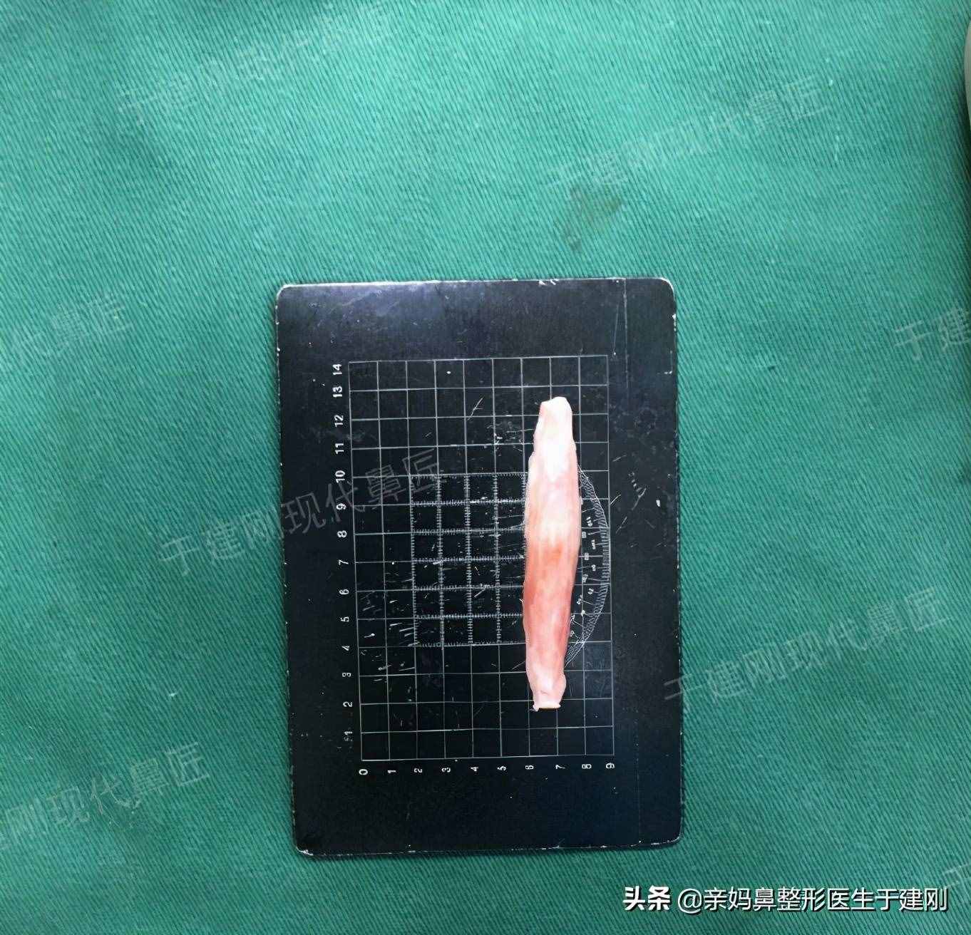 整形假体中膨体比硅胶更易感染?难取出?怎么还会有医生使用?