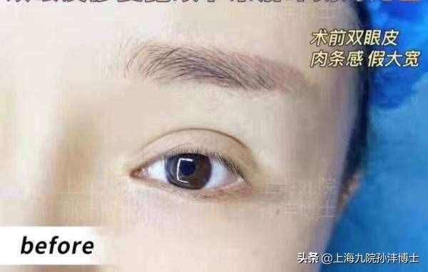 眼修复孙沣博士：全切双眼皮修复是怎么做的呢？