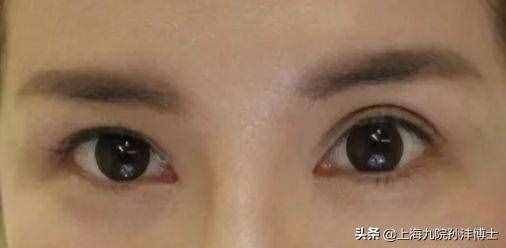 眼修复孙沣博士：全切双眼皮修复是怎么做的呢？