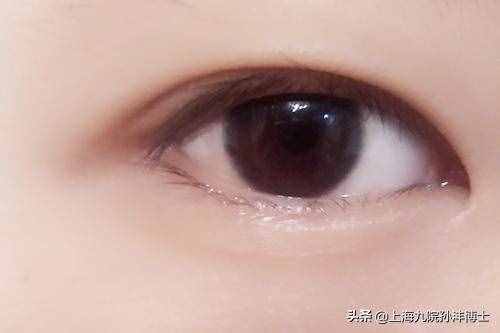 眼修复孙沣博士：全切双眼皮修复是怎么做的呢？