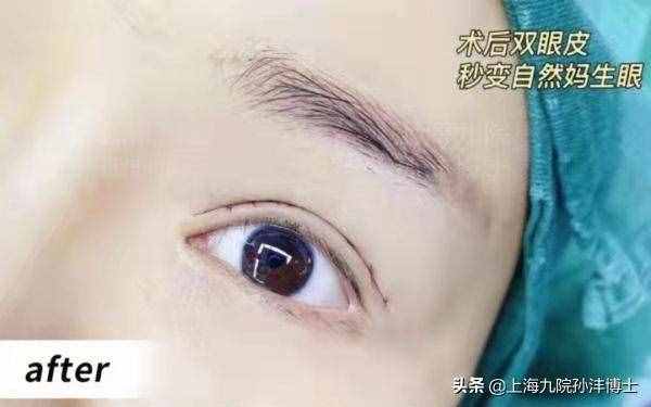 眼修复孙沣博士：全切双眼皮修复是怎么做的呢？