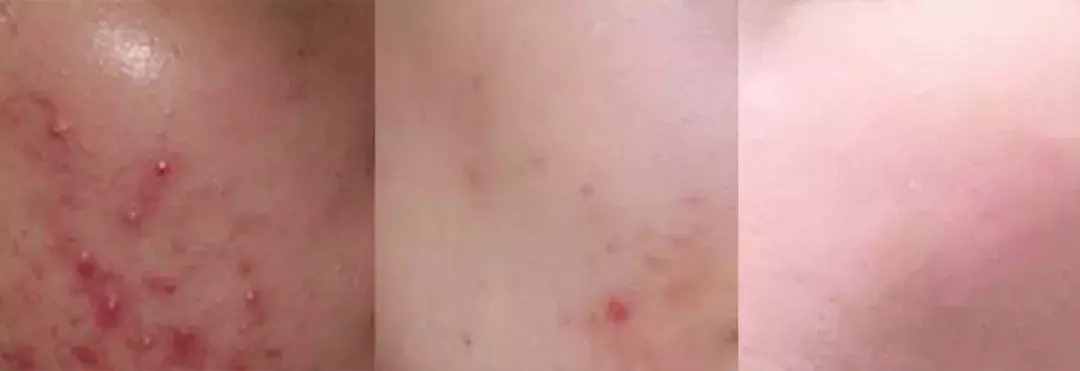 亲测上百款祛痘产品，我的大痘皮终于被这几样治好了！有图有真相