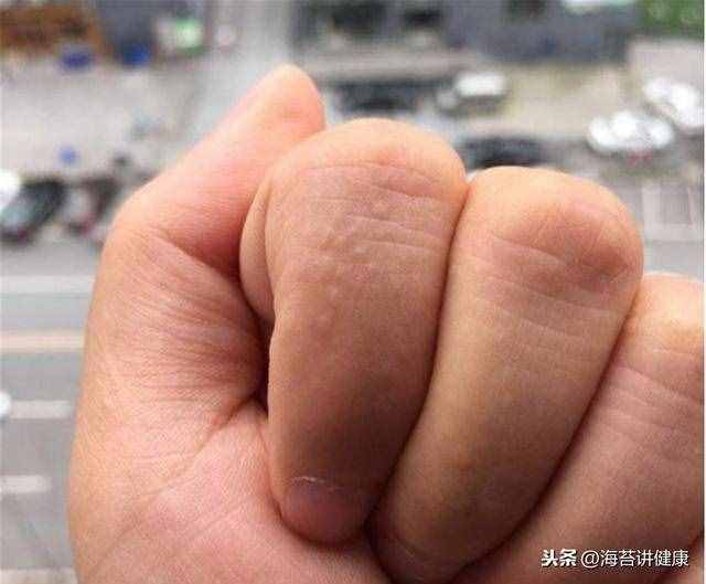 手上老是长“小水泡”？可能是这里出了问题，别再傻傻忽视了