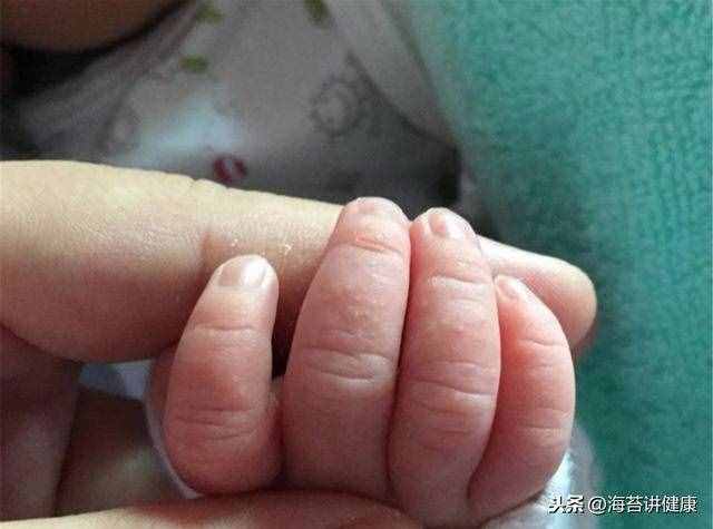 手上老是长“小水泡”？可能是这里出了问题，别再傻傻忽视了