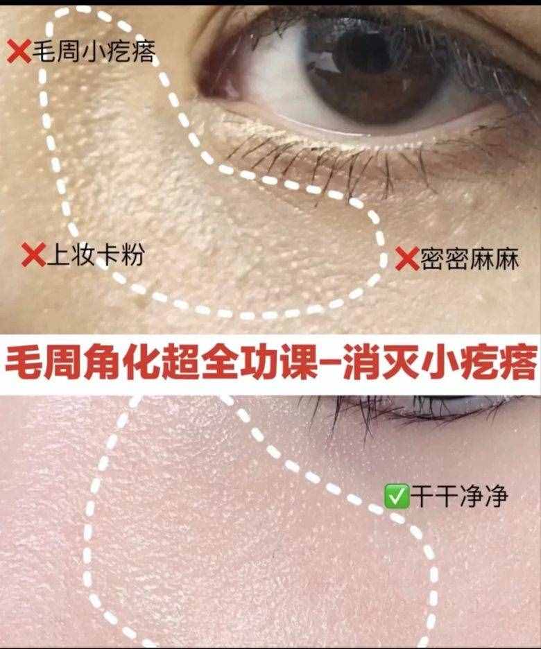 十几块搞定痘痘粉刺,你还不知道吗?