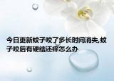 今日更新蚊子咬了多长时间消失,蚊子咬后有硬结还痒怎么办