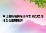 今日更新晒伤后很痒怎么处理,为什么会出现晒伤