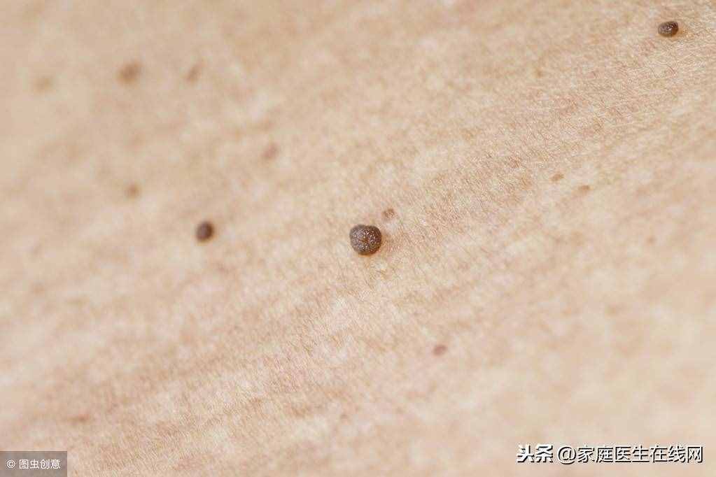身上长了扁平疣怎么办？这3个方法，总有一个能“根治”
