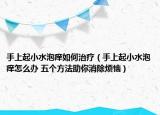 手上起小水泡痒如何治疗（手上起小水泡痒怎么办 五个方法助你消除烦恼）