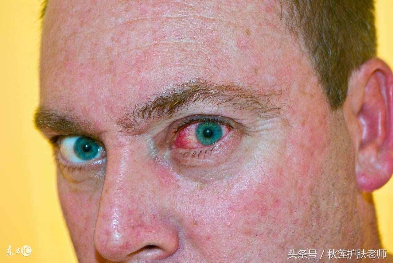 原来红血丝是不会遗传的！那先天红血丝怎么来的？可以治好吗？
