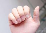 今日更新轻微灰指甲图片（指甲符合3个特点你染上灰指甲了）