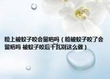 脸上被蚊子咬会留疤吗（脸被蚊子咬了会留疤吗 被蚊子咬后千瓦别这么做）