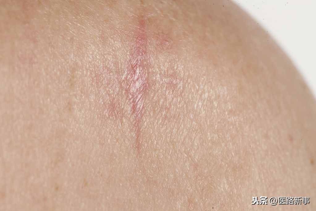 什么是鳞癌？哪些部位容易得呢？日常可以预防吗？赶快来了解