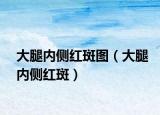 大腿内侧红斑图（大腿内侧红斑）