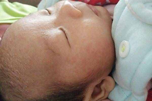 秋季天气干燥、皮炎高发，别和湿疹混淆了！两者有5大区别