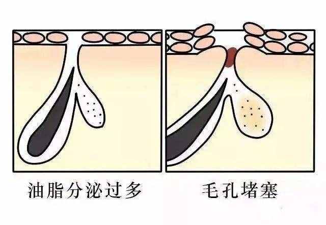 毛孔大到能种树，别慌！皮肤科医生教你如何收缩毛孔