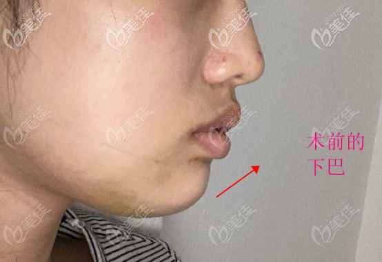 我亲身经历人工骨垫下巴的术前样子