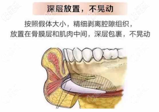 人工骨垫下巴放置的层次
