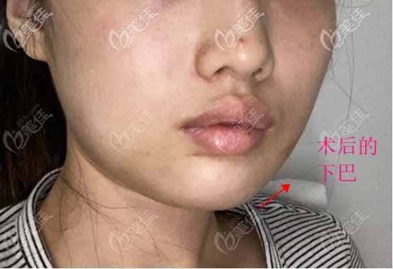 我的人工骨垫下巴效果图