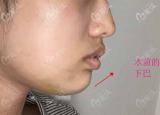 垫下巴多长时间恢复（垫下巴多少钱）
