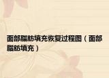 面部脂肪填充恢复过程图（面部脂肪填充）