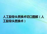 人工股骨头置换术切口图解（人工股骨头置换术）