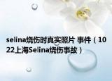 selina烧伤时真实照片 事件（1022上海Selina烧伤事故）
