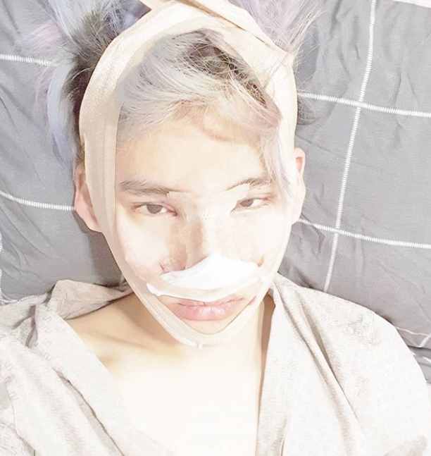 韩国男星晒整容前后对比，差距太大很惊人，被指最新照鼻尖像有坑