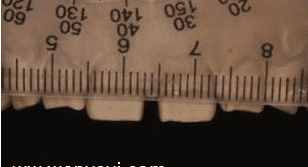 门牙有缝怎么办？