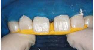 门牙有缝怎么办？