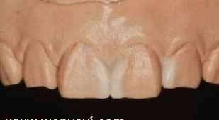 门牙有缝怎么办？