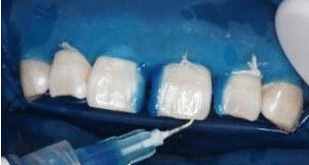 门牙有缝怎么办？