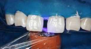 门牙有缝怎么办？