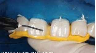 门牙有缝怎么办？