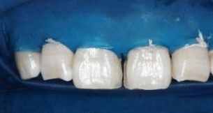 门牙有缝怎么办？