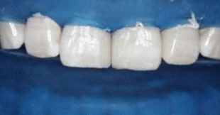 门牙有缝怎么办？