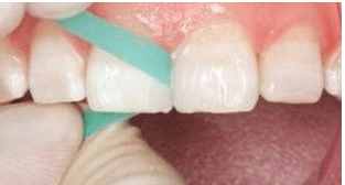 门牙有缝怎么办？