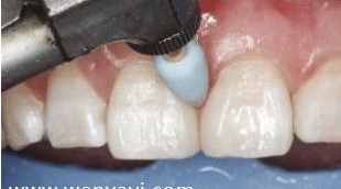 门牙有缝怎么办？