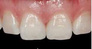 门牙有缝怎么办？