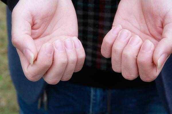 指甲上出现白斑点是怎么了？或与四个原因有关