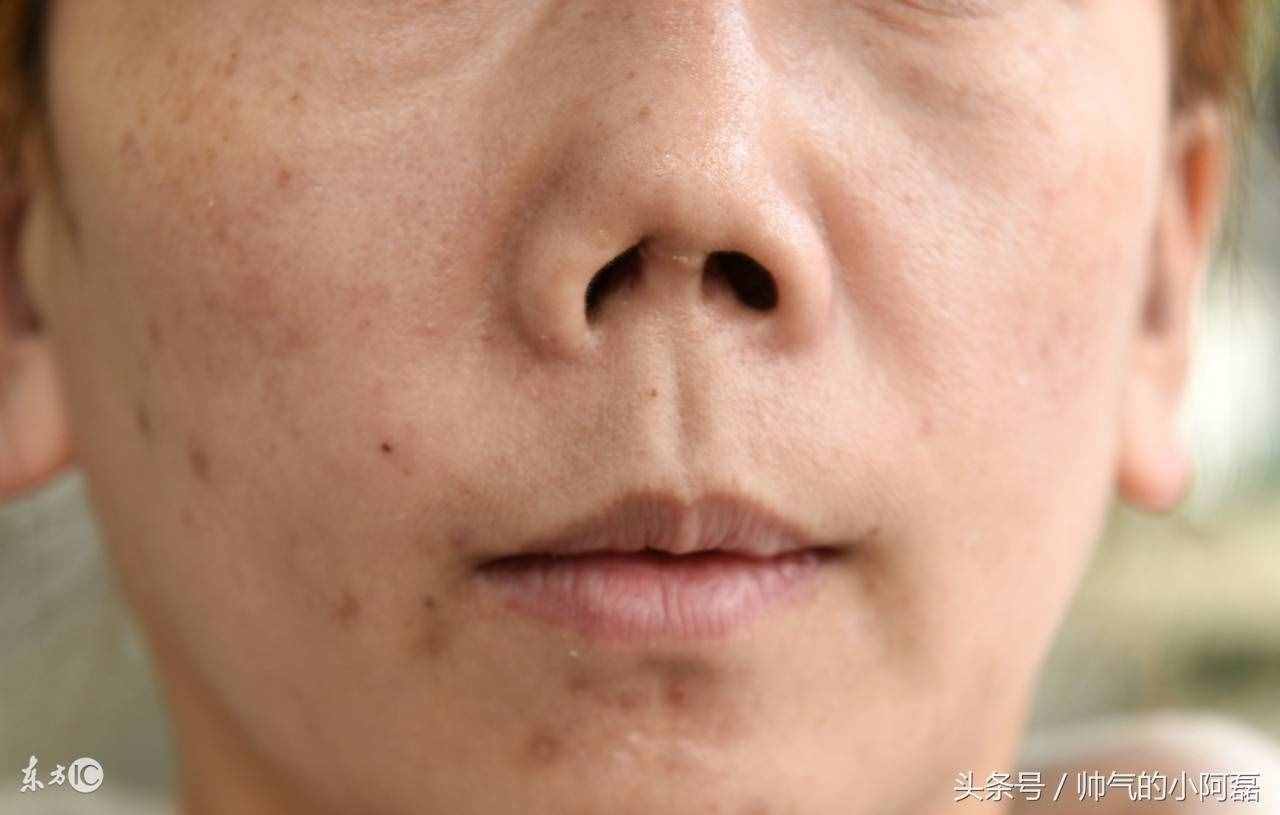 看完假体隆鼻的这3个危害 你再好好考虑