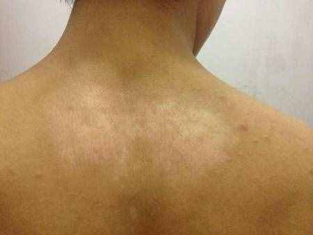 身上长花斑癣可以治疗吗