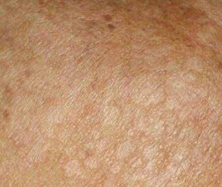 身上长花斑癣可以治疗吗