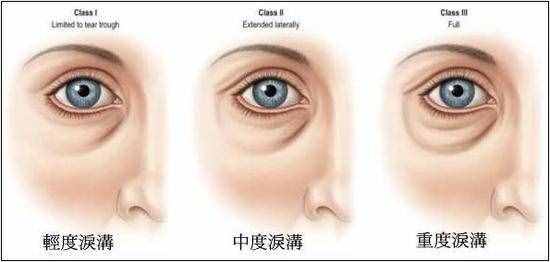 不再为泪沟发愁，这些方法可以彻底消除它们